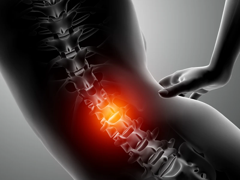 Bel omurları arasında taşan diskin kırmızı vurgulandığı anatomik görsel