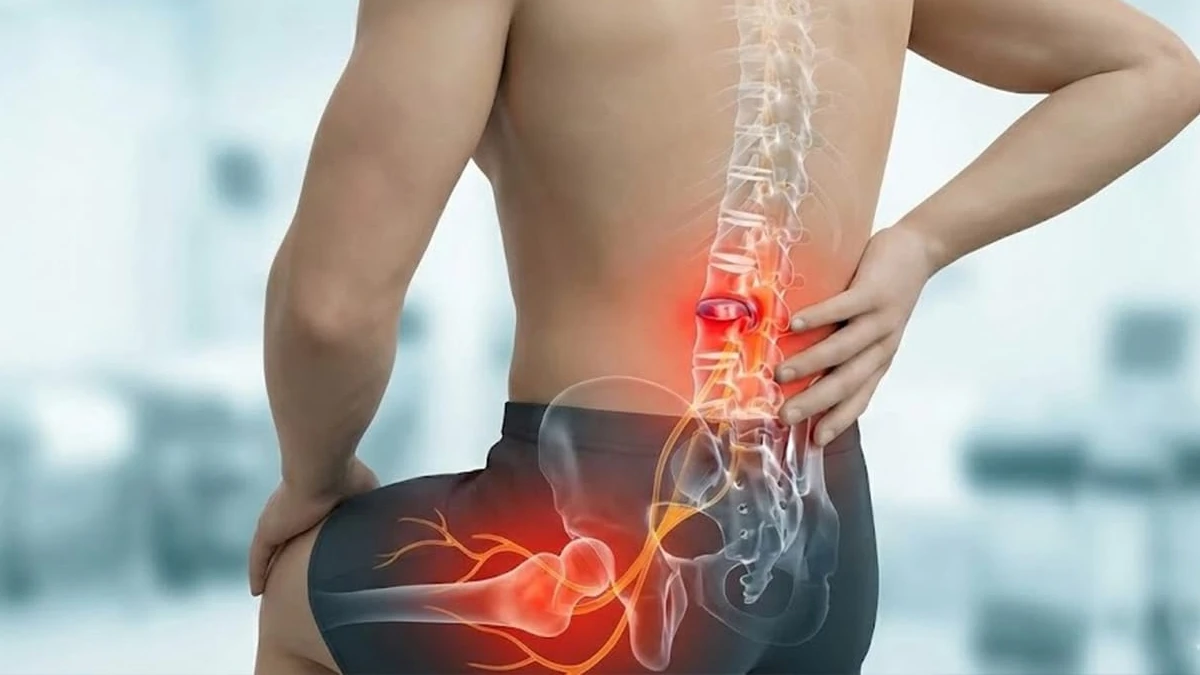 Bel omurlarında disk taşması ve bacağa uzanan sinir yolunun kırmızı vurgulandığı anatomik görsel