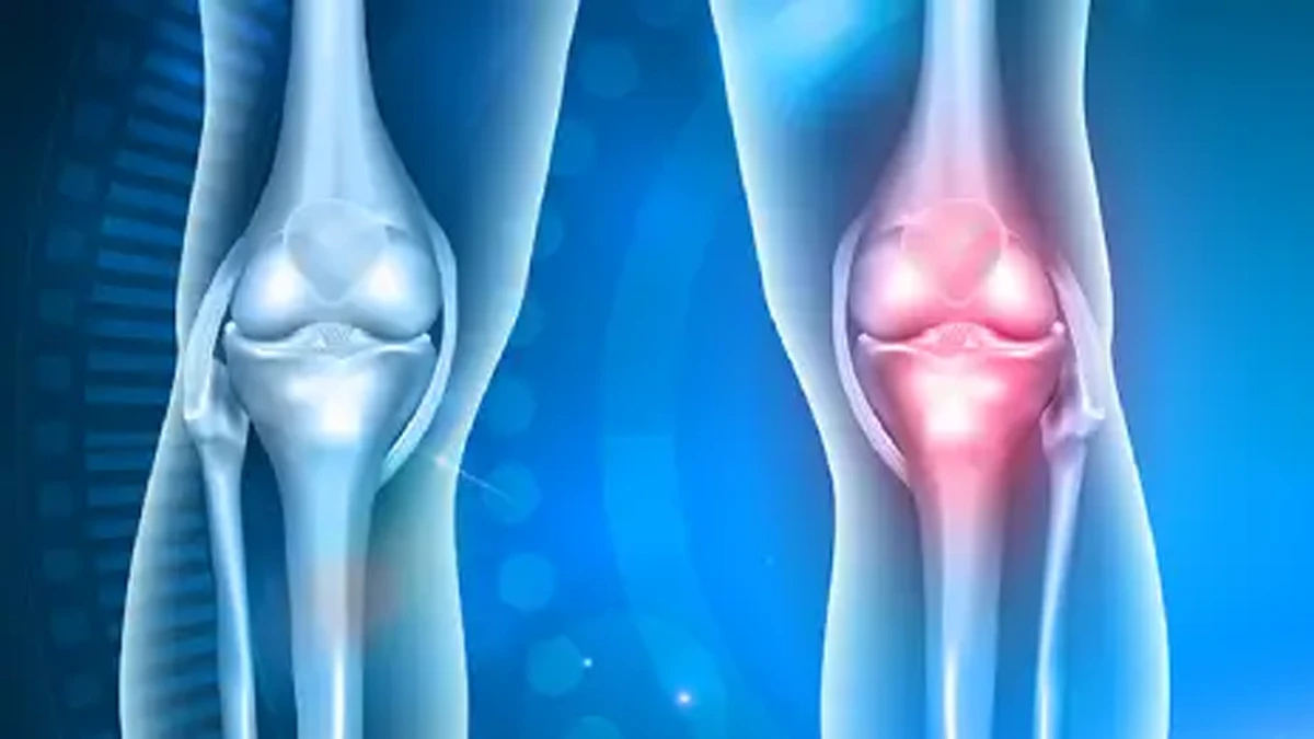 Sağlıklı diz ile ağrılı dizin yan yana karşılaştırıldığı anatomik görsel