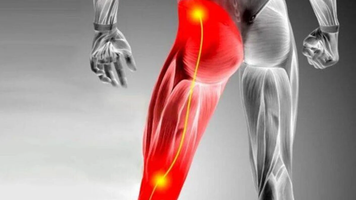 Kalçadan bacağa uzanan siyatik sinirinin sarı, ağrıyan bölgenin kırmızı gösterildiği kas anatomisi görseli